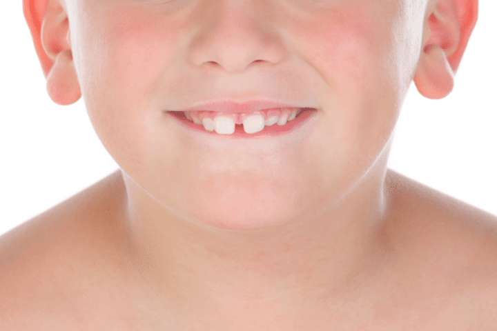 Does your child have front teeth gaps? - Smilefocus Dentist Singapore