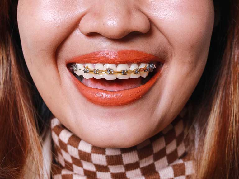 woman with braces