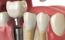 tooth-dental-implant